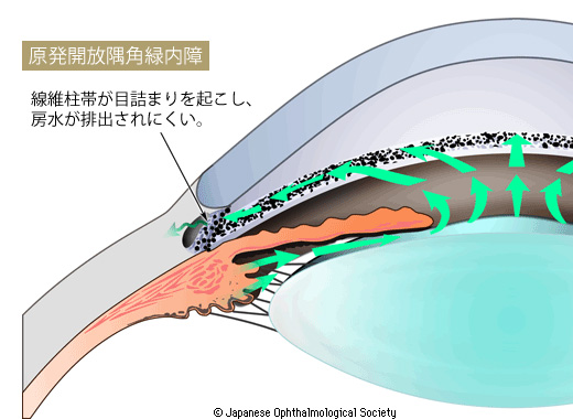 原発開放隅角緑内障