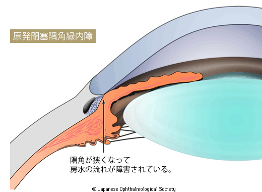 原発閉塞隅角緑内障